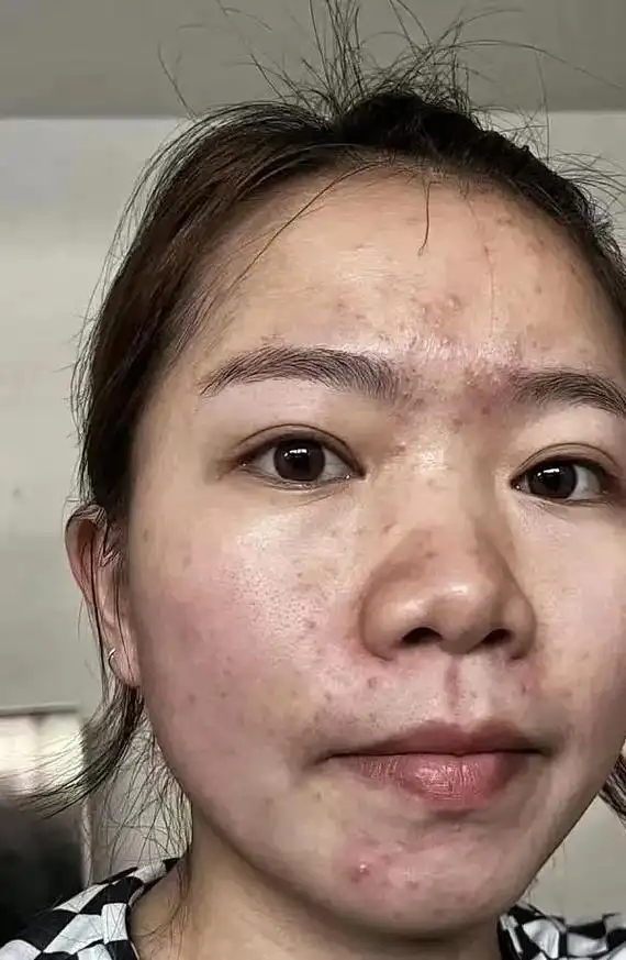 人的心态很重要,有个好的皮肤也很重要,只要脸上没了痘痘粉刺闭 - 抖