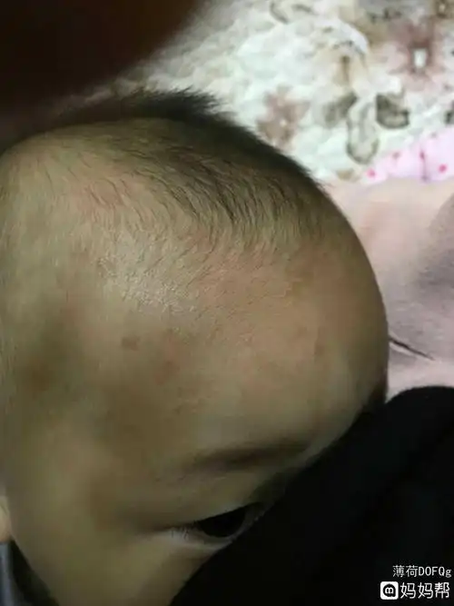 宝宝额头及眉毛处有淡褐色斑