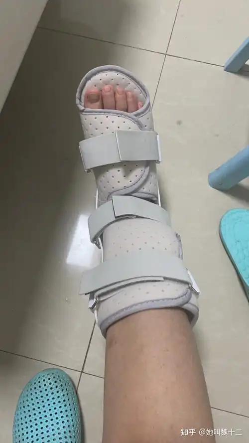 右脚第五趾骨骨折日记