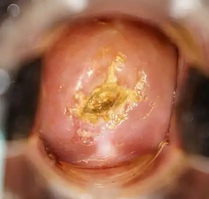 西贡区淋病医院_西贡区治疗淋病哪家医院好_西贡区治疗淋病权威的医院