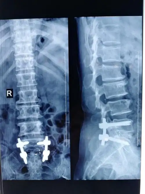 腰椎间盘突出症