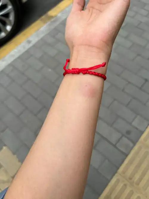 肺结核皮试又痛又痒