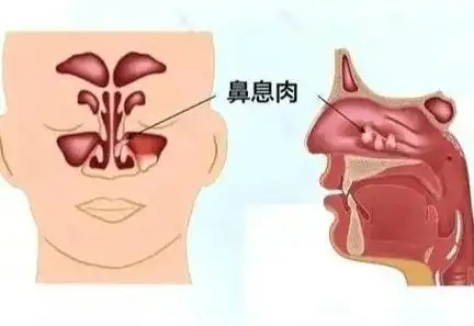 4,鼻息肉鼻炎不及时治疗还会使患者出现萎缩性鼻炎.