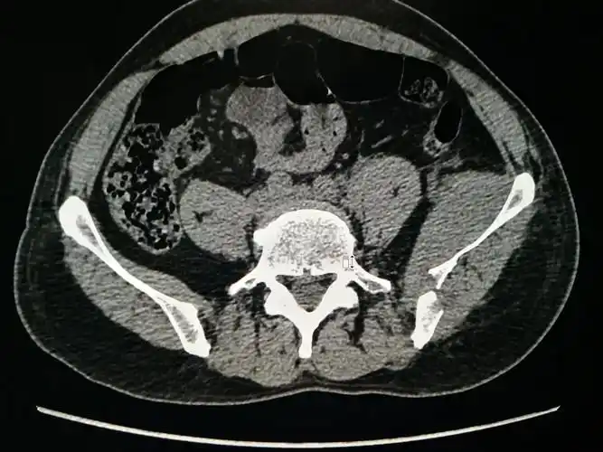 术前骨盆ct三维重建