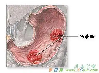 什么原因导致胃溃疡_导致胃溃疡的原因