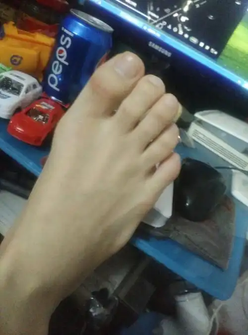脚趾外翻吗???还是正常的??_百度知道