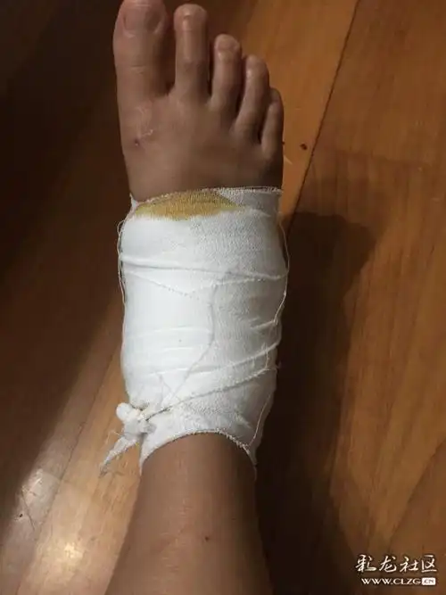 一个迈空,咔嚓,啊呀,,一阵生疼,把脚给崴了结果就到医院里了,拍了一个