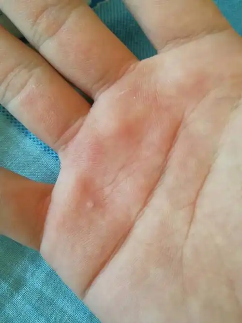 手心上的这旮瘩一样的东西很久了,自然消不了