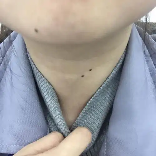 请问脖子上这个位置长痣好吗?要不要去点掉?