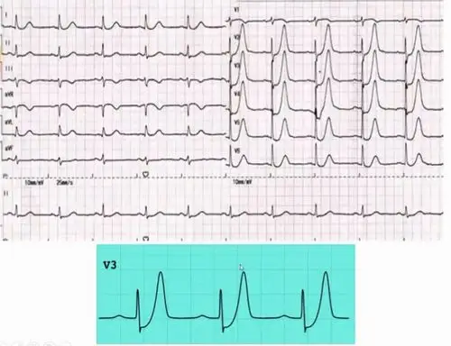 图文详解,冠心病心肌缺血的特异心电表现