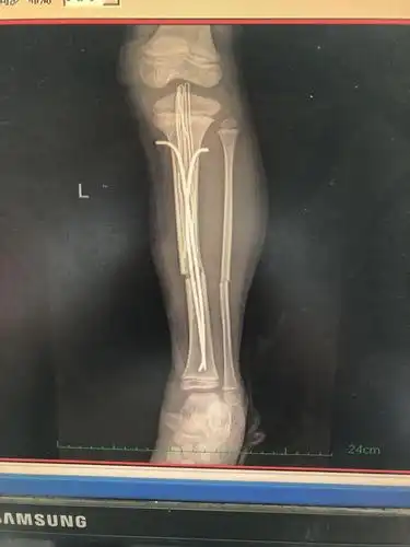 左胫骨骨折