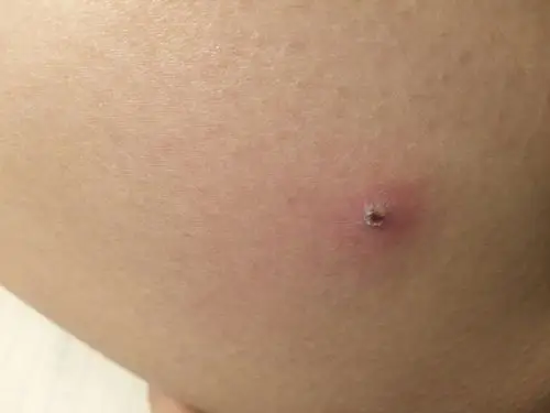 前两天大腿上长了个小包,一开始没管它,后来就开始疼,试着挤了下,也没