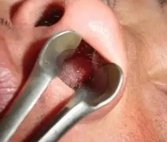 小心鼻息肉!_儿童_影响_并发症