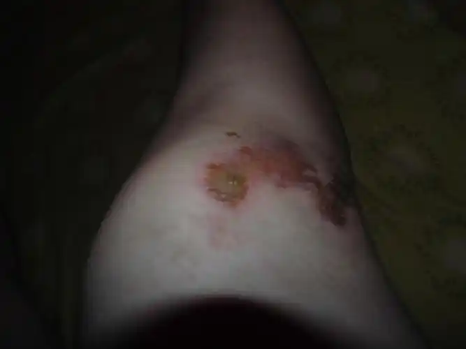 前天骑车摔了,腿擦伤了.到现在伤口成了这个样子.是不是化脓了?