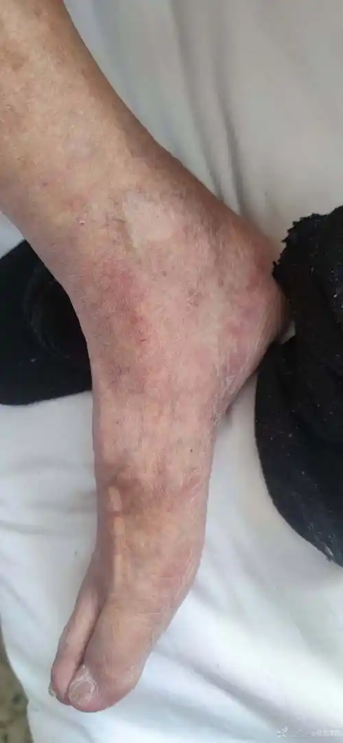 求助双足片状瘀斑