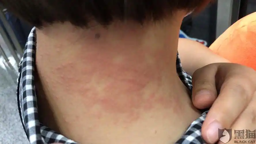 黑猫投诉:京东自营购买索尼挂颈式耳机,导致脖颈处过