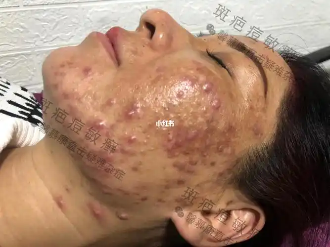 严重激素痘修复效果