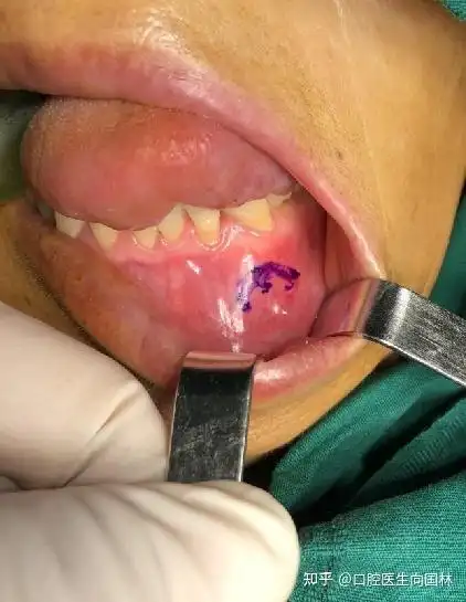 【囊肿手术案例】大型颌骨角化囊肿开窗减压联合囊肿塞治疗