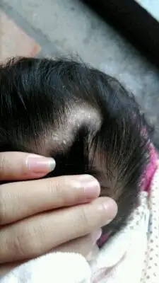 这头皮屑是什麼正常吗?