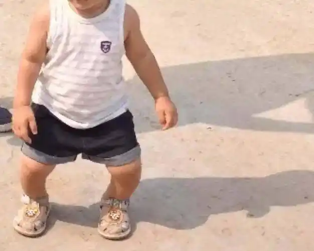 2,走路鸭行,假如孩子走路不稳或者向两侧摇摆像鸭行,并且髋关节活动