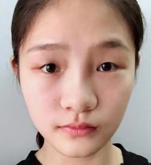 东莞割双眼皮有医院和医生推荐吗是托勿扰