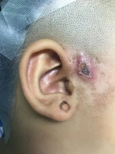 耳前瘘管感染期可以手术吗_先天性耳前瘘管_先天性耳前瘘管治疗方式