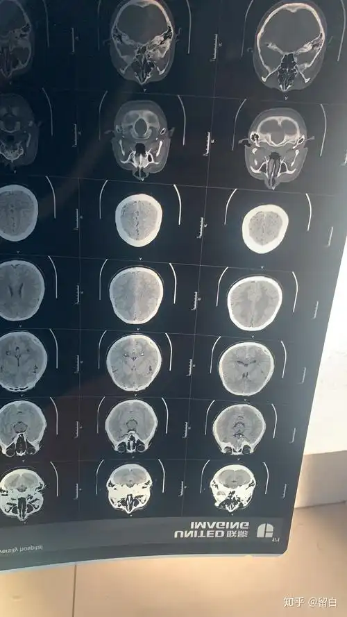 今天拍的脑部ct,取完片子大夫下班了,这个可以保守治疗吗,就第一天