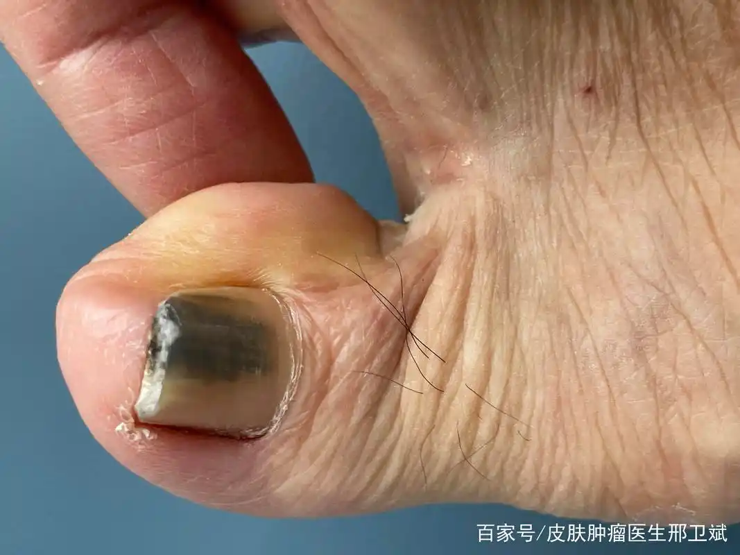 指甲变黑怎么办?