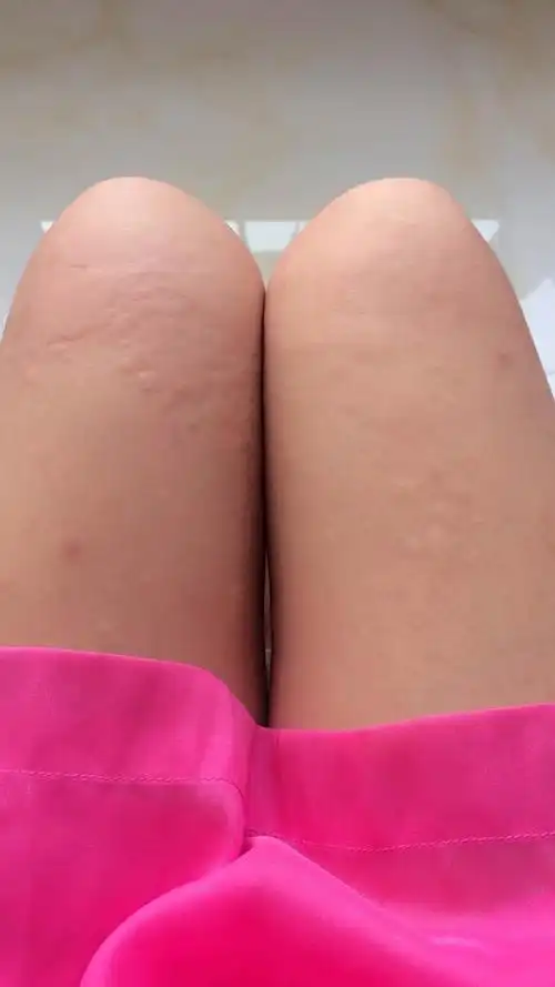 早上起床宝贝腿上起了好多大包,不知是过敏还是荨麻疹,奇痒无比,用