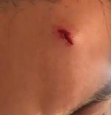 李晨额头受伤坚持录制却被吐槽作秀,跑男导演回应一句话超暖心