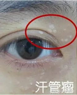 小伊支招:眼周爱起脂肪粒怎么破?