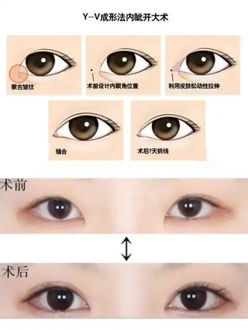 医生准备割双眼皮但是我适合开眼角吗71