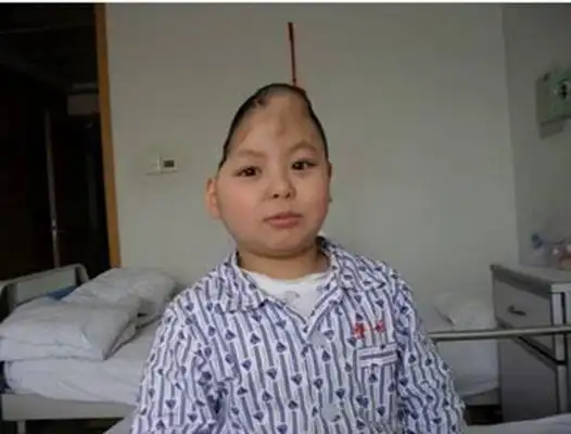 无脑儿 (3)_有来医生