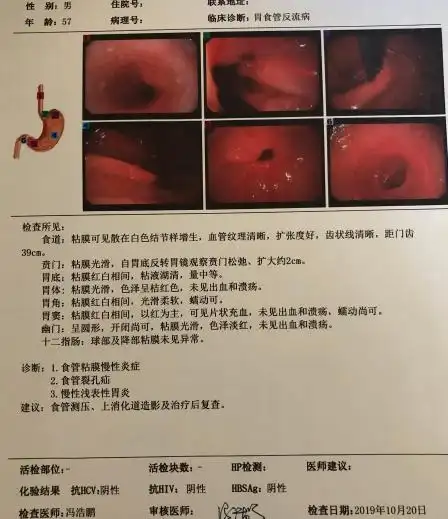 食管裂孔疝手术多少钱食管裂孔疝造成的胸闷咳嗽