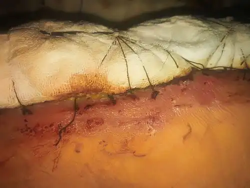 大腿植皮手术失败案例