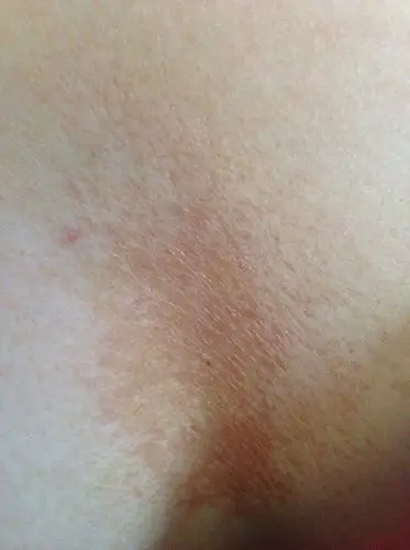 女28未婚,上个星期胸口乳沟正中长了四颗红色点点,有点像痘痘,但又痛