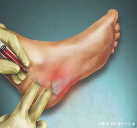脚后跟疼痛是骨刺造成的吗?
