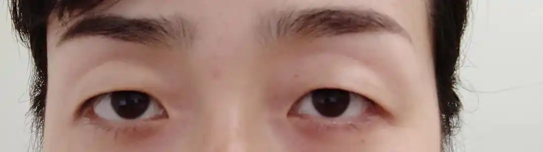 眼窝凹陷眼球凸出怎么办