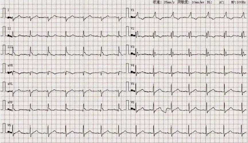 因偶发胸闷心悸就诊,图为其心电图结论:窦性心律完全性右束支传导阻滞