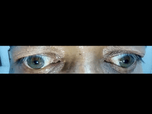 这8种眼震你都能分清吗附动图及影像