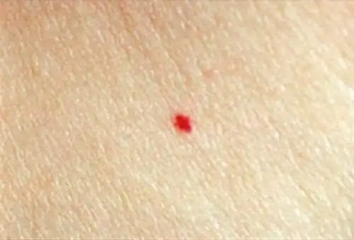 正常红痣的图片区别(带你全面认识普通红痣) - 长城号