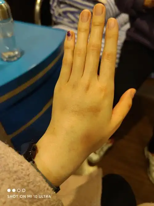 挂了6天的水,次次挂水次次鼓包,烦死了#住院日记  #挂水  #淤青  #肿