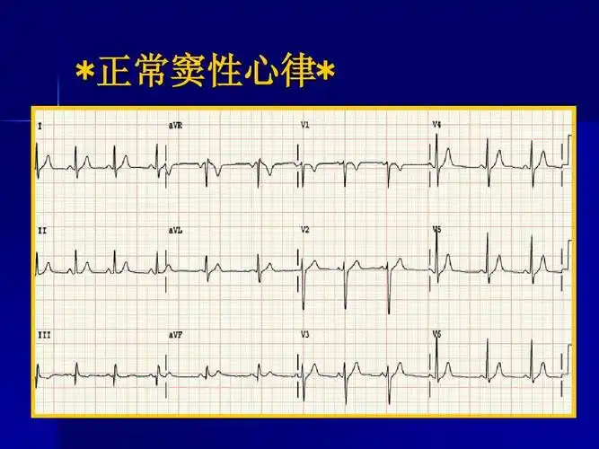 窦性心律失常 06-5心电图检查 microsoft powerpoint 演示文稿ppt