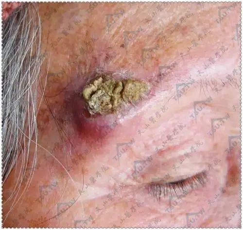 鳞状细胞癌鳞癌表皮样癌