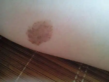 左腿的小腿上有一个椭圆形的褐色胎记,请问可以祛除麽?激光大概要多少