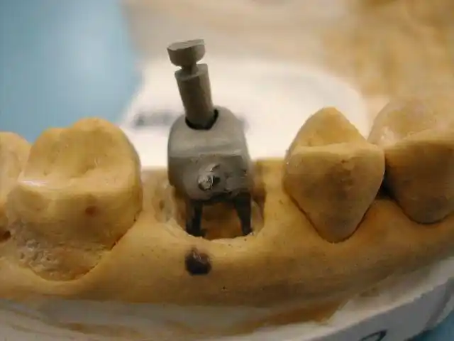 后牙残冠分体桩核修复