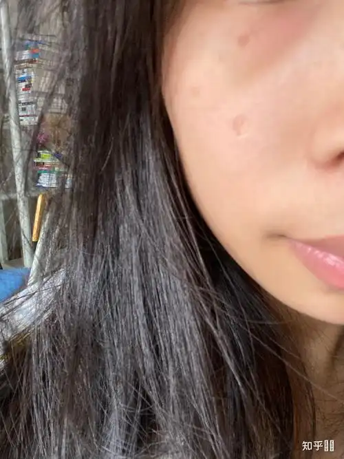 女生脸上有疤是怎样的体验?