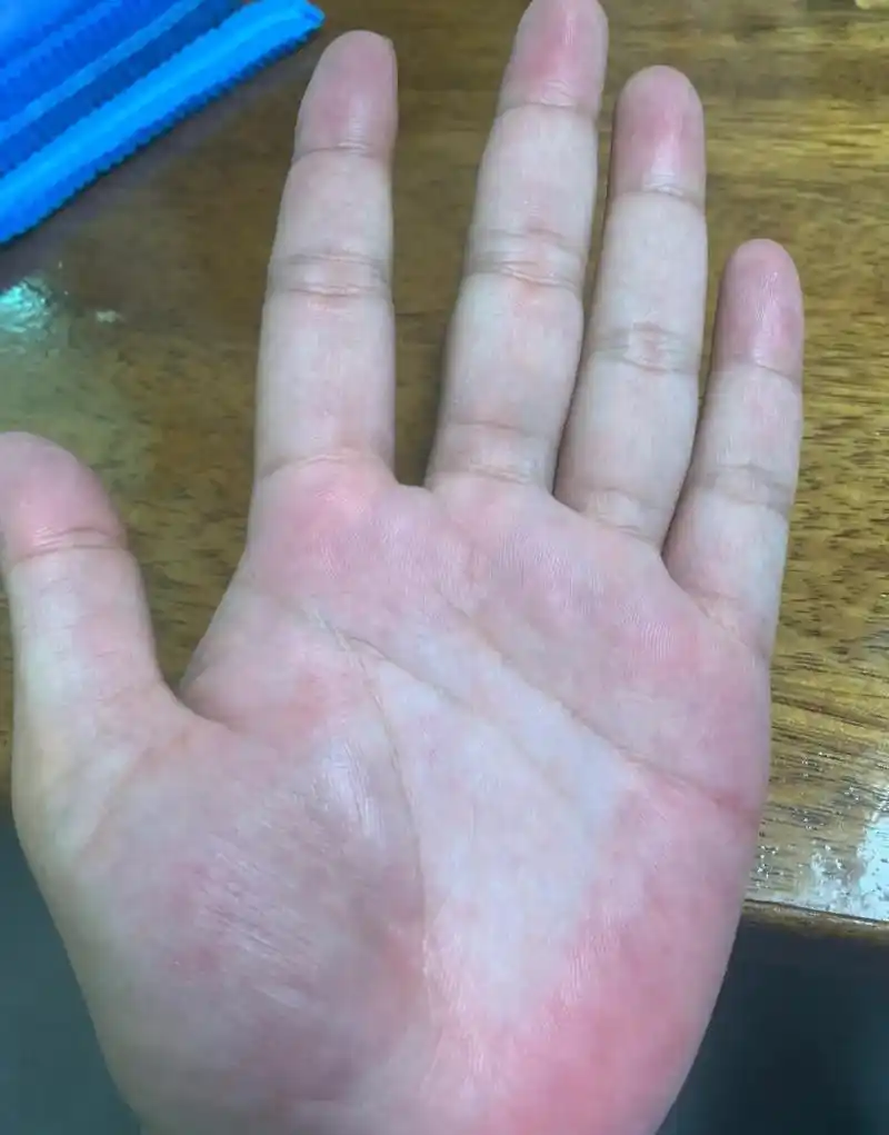 给大家看一个图片,这就是肝掌,很明显的就能看出,手掌的大小鱼际处