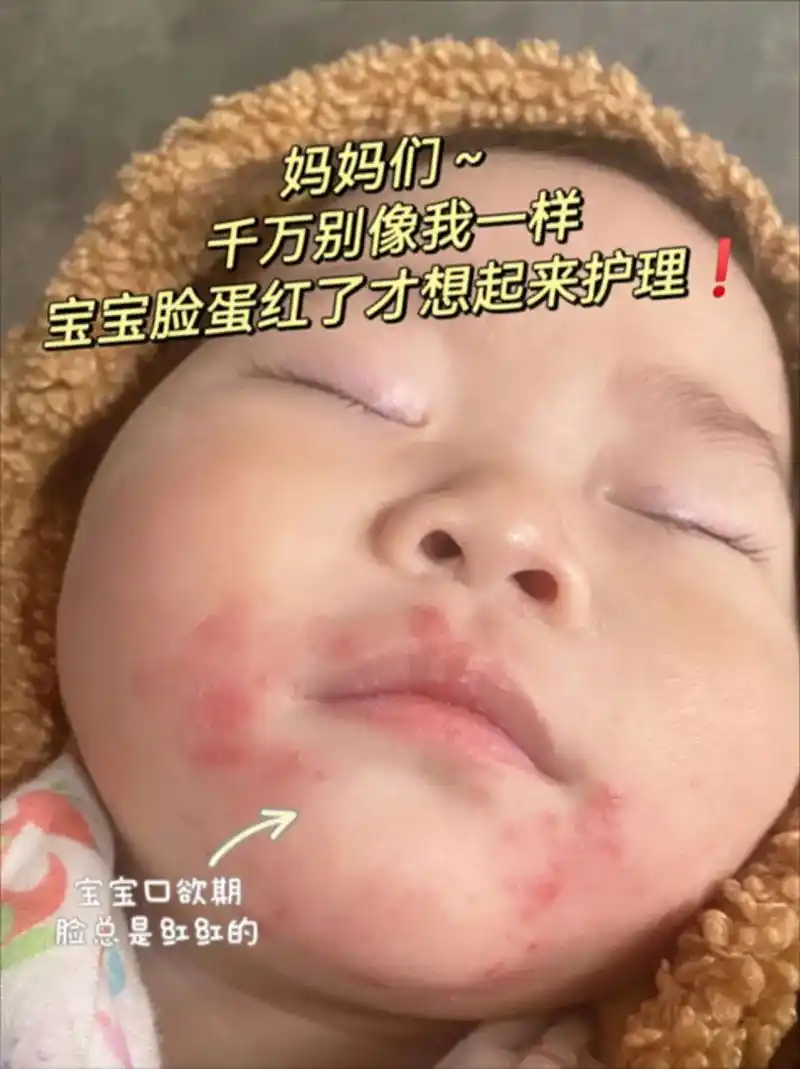 宝宝开始长牙后很容易出现口 - 抖音