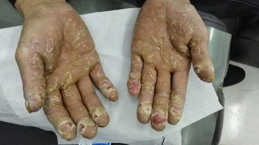 手严重脱皮,影响全身皮肤癣,引起手脚灰指甲.